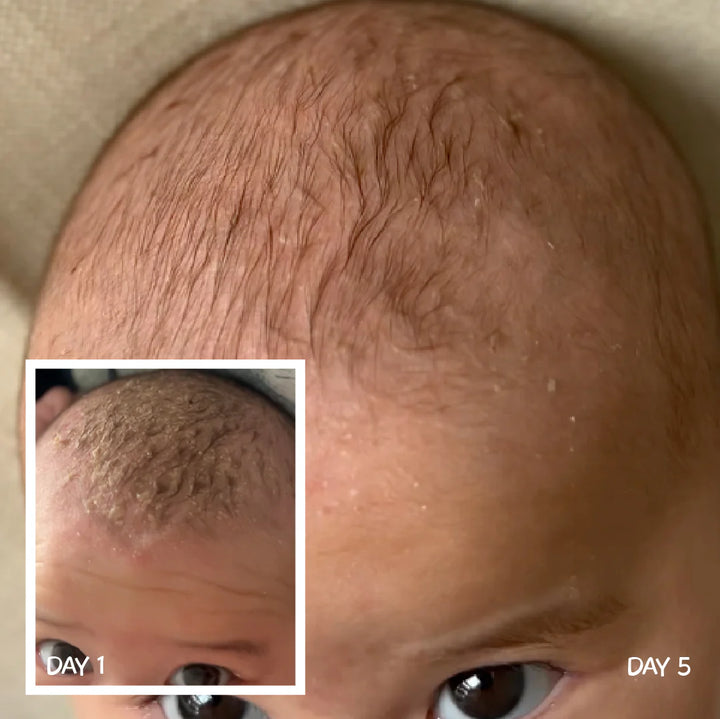 Moogoo BABY Cradle Cap Scalp Cream 120g