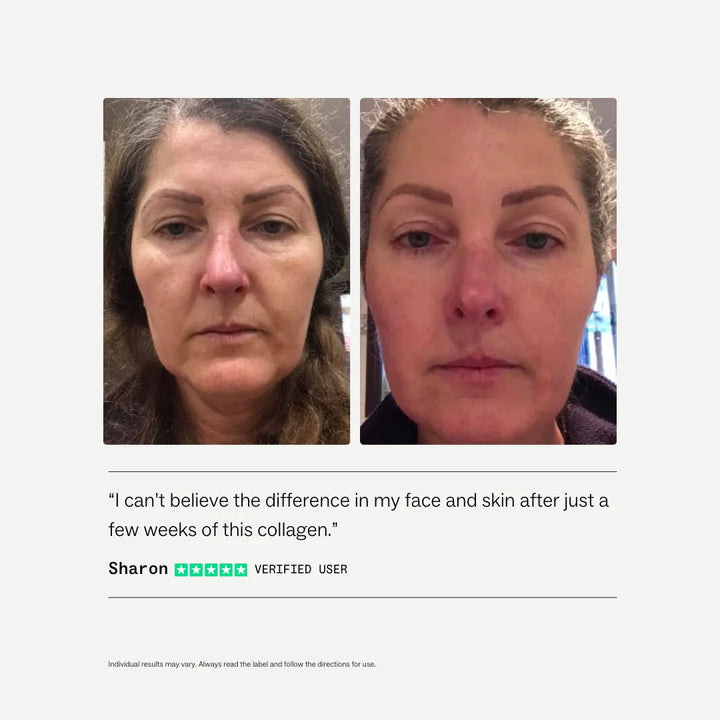 Before and after comparison of a woman's face with text about collagen product.