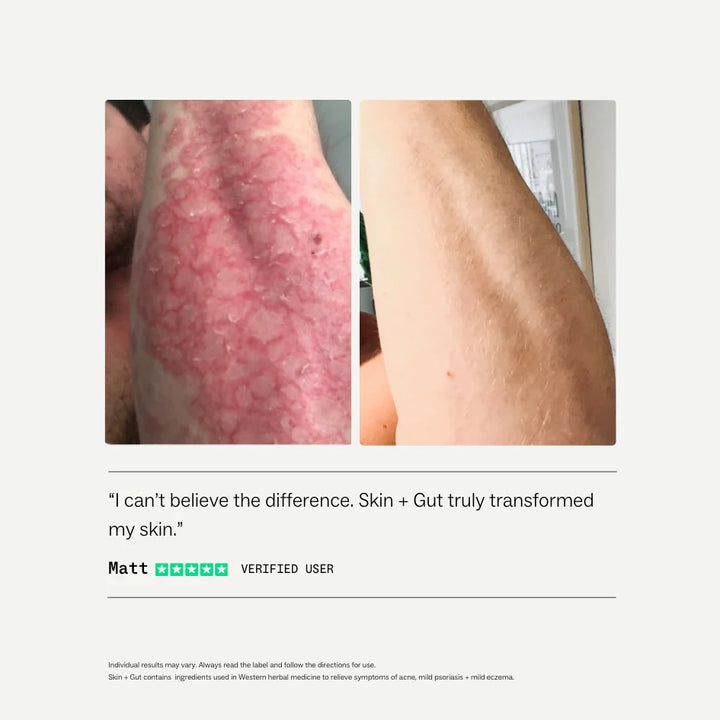 Before and after comparison of skin condition on a person's arm with a verified user testimonial.