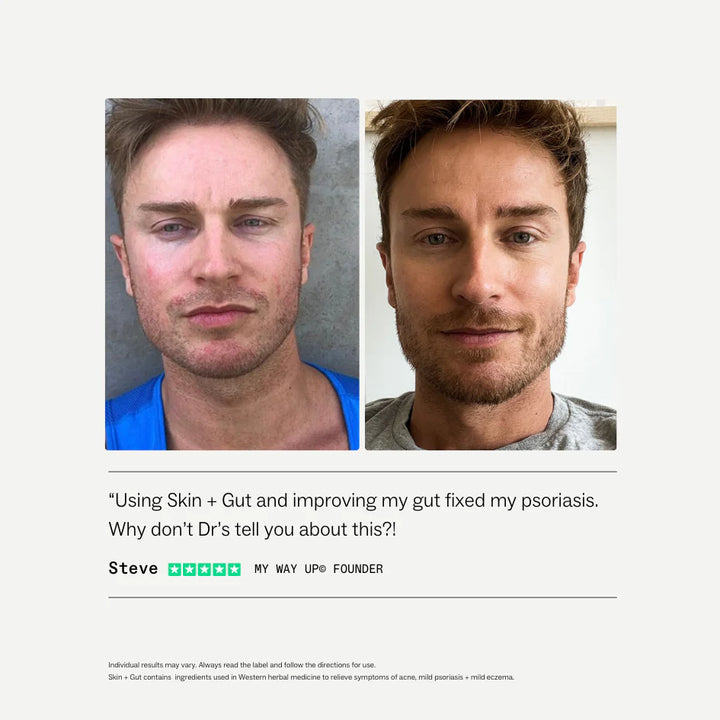 Before and after comparison of a man's face with text about using Skin + Gut for psoriasis treatment.